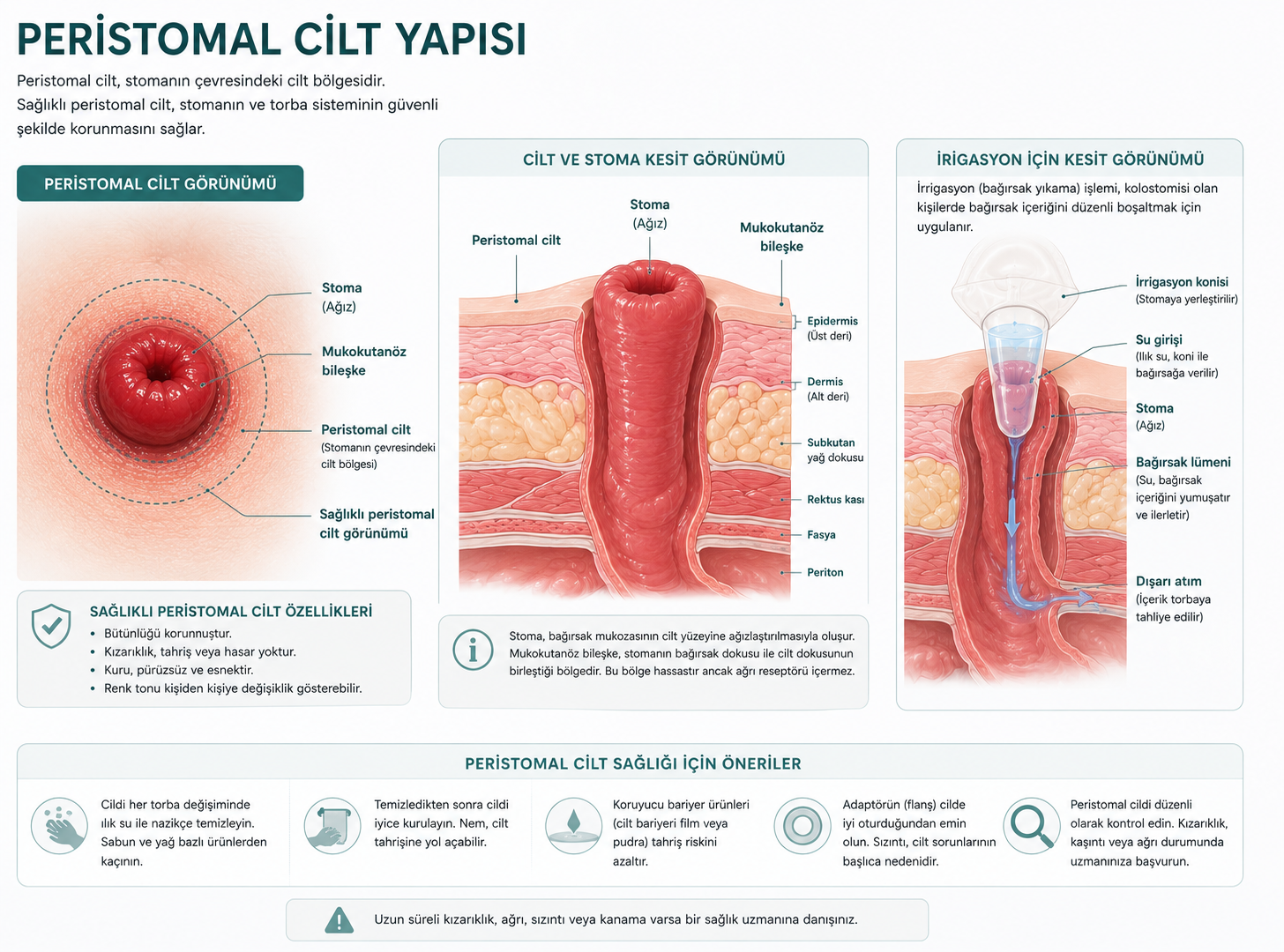 Peristomal cilt yapısı — stoma, bariyer (adaptör), peristomal bölge ve torba kesit görünümü